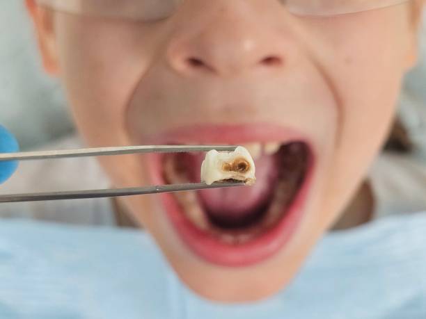 Best Emergency Wisdom Teeth Removal in Alpha, NJ